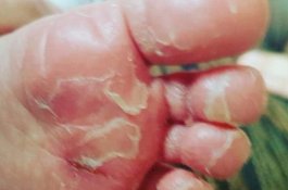 Ngeri! Sepatu Jeli Membuat Kaki Balita ini Melepuh