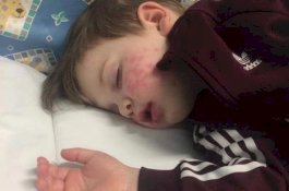 Gara-gara Dicium, Anak Usia 3 Tahun Ini Terkena Herpes