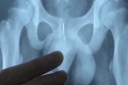 Bocah 13 Tahun Masukkan Jarum ke Itunya Agar Tidak Ketiduran Kerjakan PR