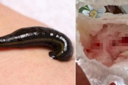 Lintah Ini Masuk ke Alat Kelamin Gadis 4 Tahun dan Mengisap Darahnya