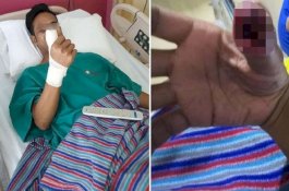 Jempol Pemuda Ini Nyaris Diamputasi Setelah Tanpa Sadar Teriris Pelindung Layar yang Retak
