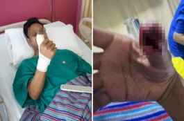 Anti Gores Smartphone Retak, Jempol Pria Ini Nyaris Diamputasi