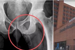 Alat Vital Pria Ini Berubah Jadi Tulang karena Kondisi Medis yang Langka