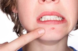 4 Cara Alami untuk Mengobati Bisul