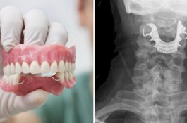 Gigi Palsu Kakek Tersangkut di Tenggorokan Selama Operasi, Dokter Baru Lihat 8 Hari Kemudian