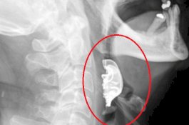 Gigi Palsu Kakek Hilang Sejak Operasi, Ternyata Masuk ke Tenggorokannya