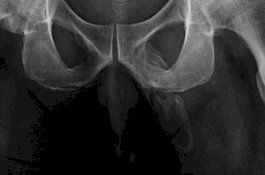 Akibat Jatuh, Mr P Pria Ini Berubah Menjadi Tulang