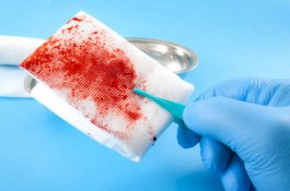 Kain Kasa Tertinggal di Usus Pasien Usai Operasi, Dokter Sebut Pasien yang Makan