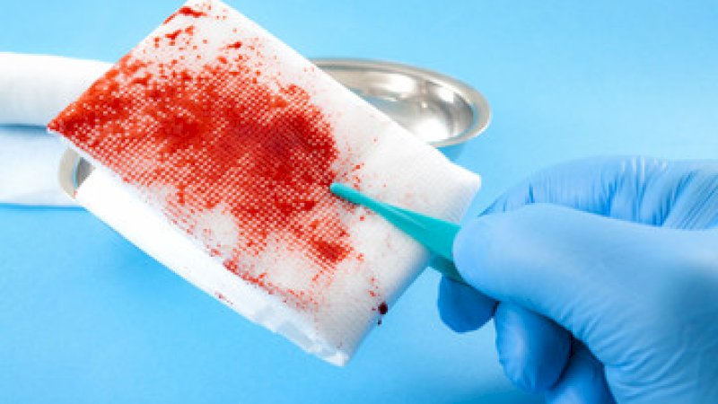 Kain Kasa Tertinggal di Usus Pasien Usai Operasi, Dokter Sebut Pasien yang Makan