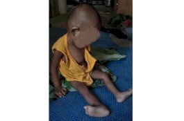 Balita Resky, Penderita Polio dan Asupan Gizi Kurang Ditangani Serius Pemkot Parepare