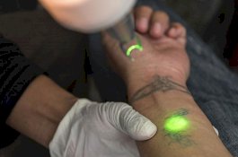5 Cara untuk Menghapus Tato Permanen