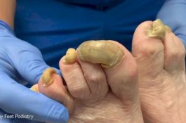 Setahun Tak Dipotong, Kuku Kaki Wanita Ini Tumbuh Tak Lazim dan Terinfeksi Jamur