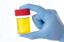 Cek Kesehatan Anda dengan Urine, Bila Berbau Amis Waspada Penyakit Ini