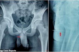 Remaja 14 Tahun Ini Tak Bisa Kencing 3 Hari Setelah Masturbasi dengan Jarum