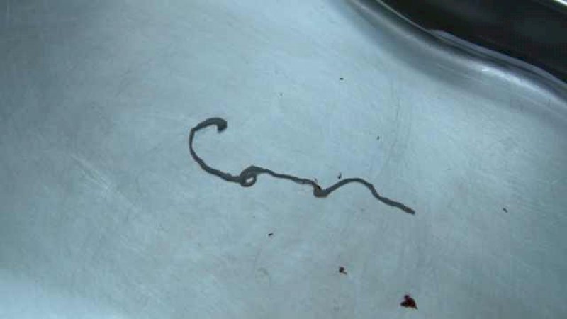 Sakit Kepala Sejak 30 Tahun Lalu, Ternyata Ada Parasit di Kepala Pria Ini