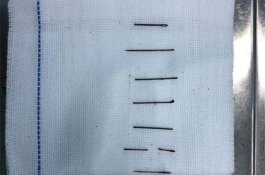 Dokter Keluarkan 8 Jarum dari Pantat Pasien yang Tertancap Selama 10 Tahun