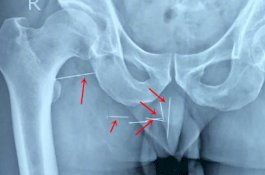 10 Tahun Rasakan Sensasi Menusuk dan Geli di Pantatnya, Ternyata ada 8 Jarum Jahit