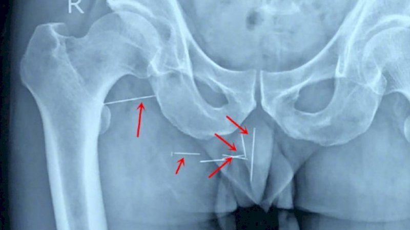 10 Tahun Rasakan Sensasi Menusuk dan Geli di Pantatnya, Ternyata ada 8 Jarum Jahit