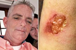 Awalnya Dikira Flu, Pria Ini Harus Kehilangan 25% Kulitnya Dimakan Bakteri