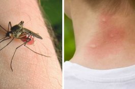 Mengenal Skeeter Syndrome: Reaksi Alergi Terhadap Gigitan Nyamuk