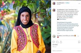 Derita Scleroderma, Farah Khaleck Takut Bercermin dan Berfoto