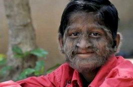 Minum Obat Sirup, Sejumlah Bayi di Spanyol Wajahnya Dipenuhi Rambut