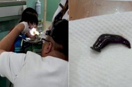 Ngeri... Batuk Berdarah 10 Hari, Ternyata Ada Lintah Hidup di Kerongkongan