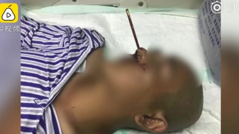 Gatal di Hidung, Pria Ini Ngupil Pakai Sumpit Berakhir di RS