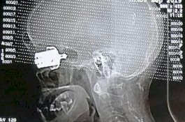 Ngeri! Panci Presto Meledak dan Peluitnya Menusuk Mata Wanita ini