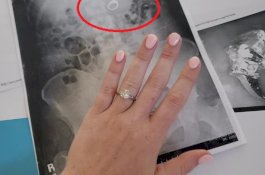 Wanita ini Menelan Cincin Pertunangannya Saat Mimpi Buruk