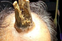 'Tanduk Iblis' Sepanjang 10 Cm Berhasil Dihilangkan dari Kepala Pria India
