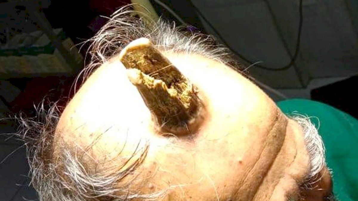 'Tanduk Iblis' yang Ada di Kepala Pria Ini Berhasil Diangkat Dokter