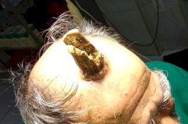 Dokter Cabut 'Tanduk Iblis' dari Kepala Pria Ini