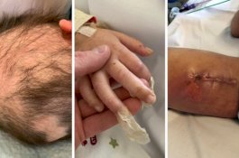 Luka di Kaki, Balita Ini Terinfeksi Bakteri Pemakan Daging