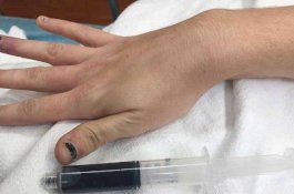 Aneh! Darah Wanita Ini Menjadi Biru Setelah Minum Obat Sakit Gigi