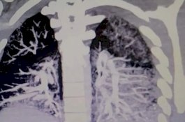 X-ray Tunjukkan Paru-paru Pengguna E-Rokok Dilapisi Minyak Mengeras