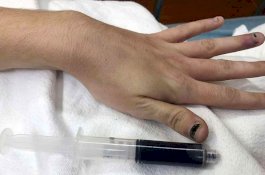 Darah Wanita Ini Menjadi Biru, Dokter Temukan Penyebabnya