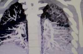 Awalnya Dikira Bronkitis, Remaja Pecandu Vaping Ini 'Simpan' Minyak di Paru-paru