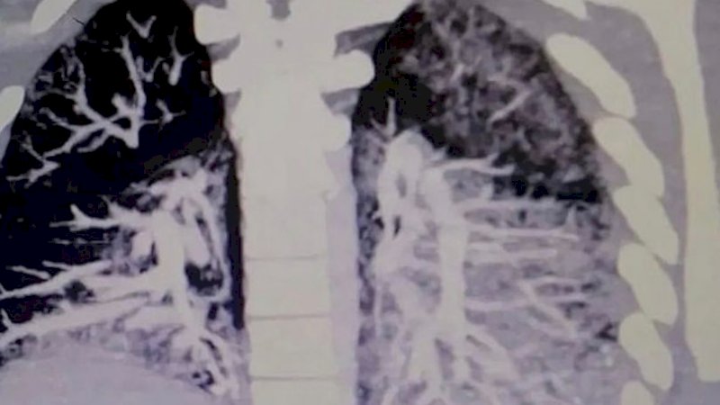 Awalnya Dikira Bronkitis, Remaja Pecandu Vaping Ini 'Simpan' Minyak di Paru-paru