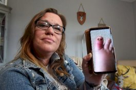 Berawal dari Kuku Gangreng, Kaki Penderita Diabetes ini Harus Diamputasi