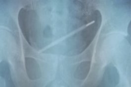 Pria ini Masukkan Termometer ke P*nis, Terjebak di Kandung Kemih 11 Hari