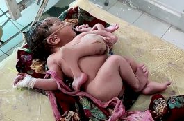 Kasian, Bayi Perempuan Lahir Dengan 4 Kaki dan 3 Tangan