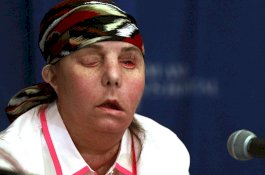 Enam Tahun Kemudian, Transplantasi Wajah Wanita ini Gagal