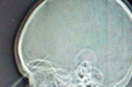 Ngilu... Mata Bocah Ini Tertusuk Pensil, Hampir Tembus Dahi dan Masuk Otak