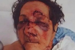 Anak Posting Wajah Babak Belur Ibunya, Katanya Dipukuli di Panti Jompo