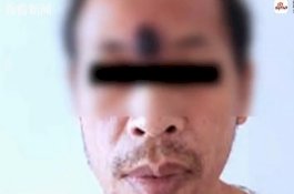 Pria ini Pencet Jerawat di Dahinya, Ternyata Tumor Ganas