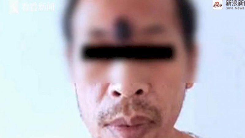 Pria Ini Pencet-pencet Jerawatnya, Eh Ternyata Tumor