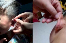 Tak Kerjakan PR, Kuping Anak 10 Tahun Distaples Guru