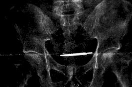 Asli Nekat, Tahanan Ini Telan Pisau Bedah untuk Diselundupkan ke Sel