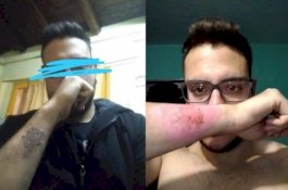 Ingin Daftar Polisi, Pria Ini Hapus Tato Pakai Parutan Keju